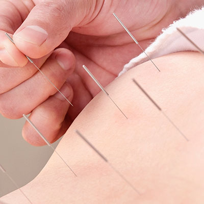 Akupunktur